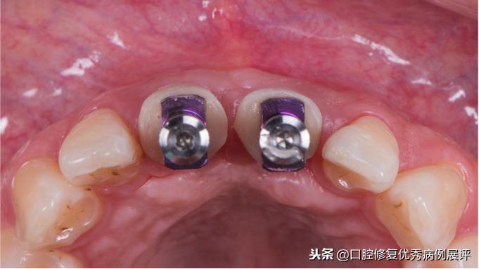 展评优秀病例赏析|Asc全瓷角度基台一体冠进行种植前牙美学修复