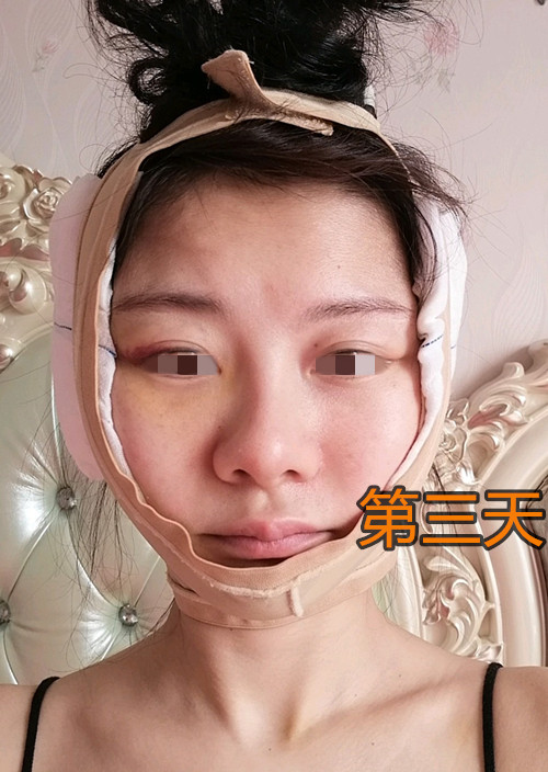 内窥镜拉皮除皱效果,48岁做内窥镜拉皮手术亲身经历