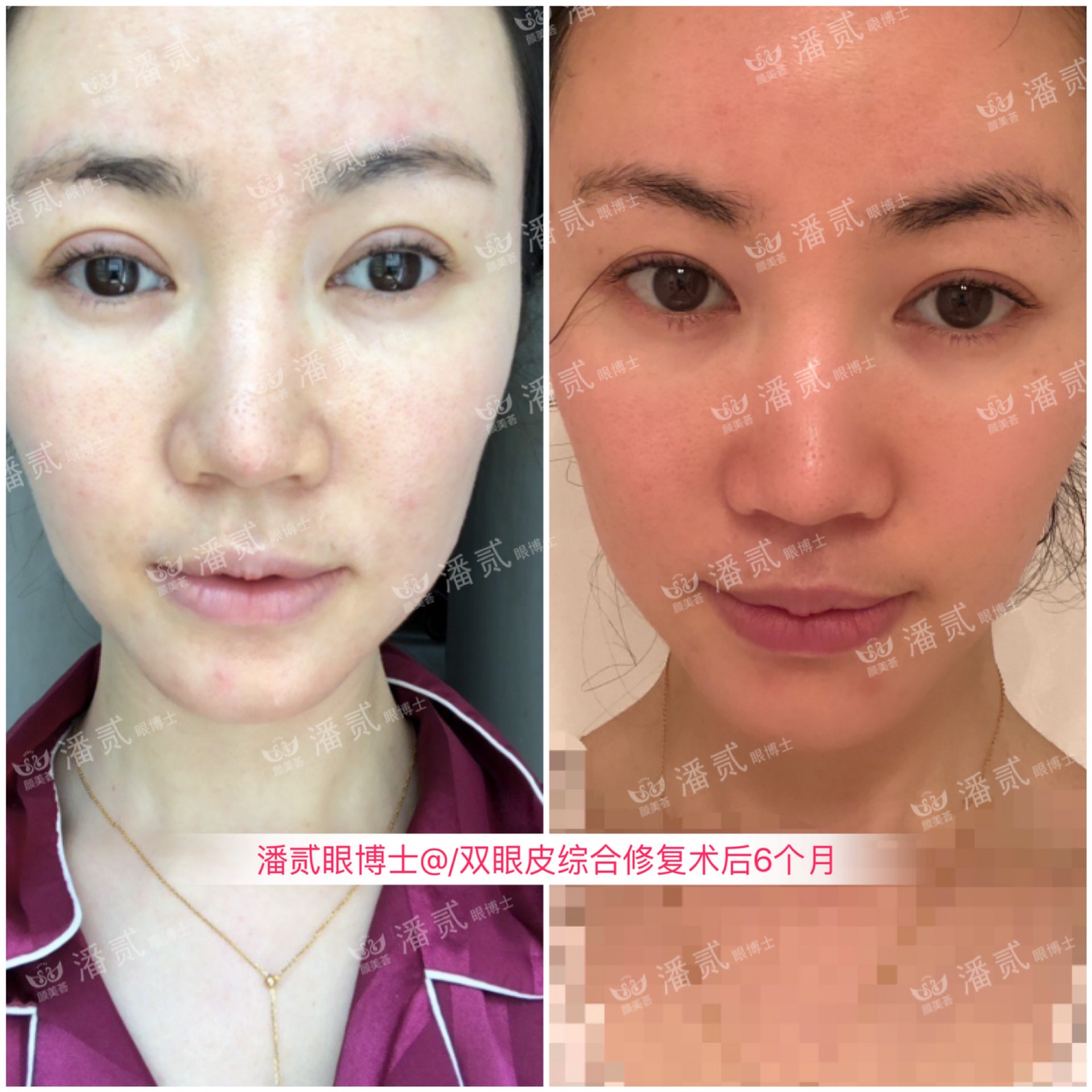 广州双眼皮修复内双,广州双眼皮修复可以只修眼尾吗