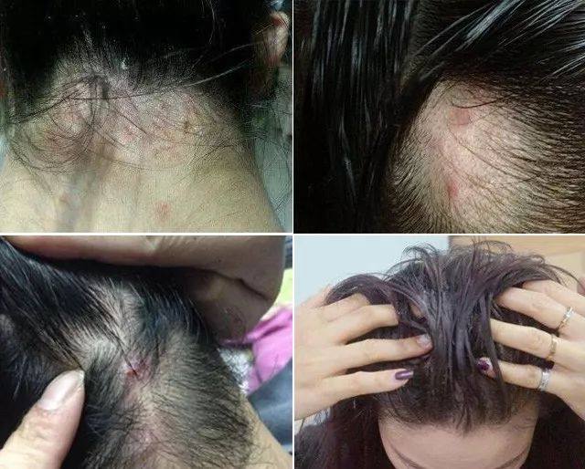 白天身上螨虫多是什么症状,身上螨虫多影响护肤吗