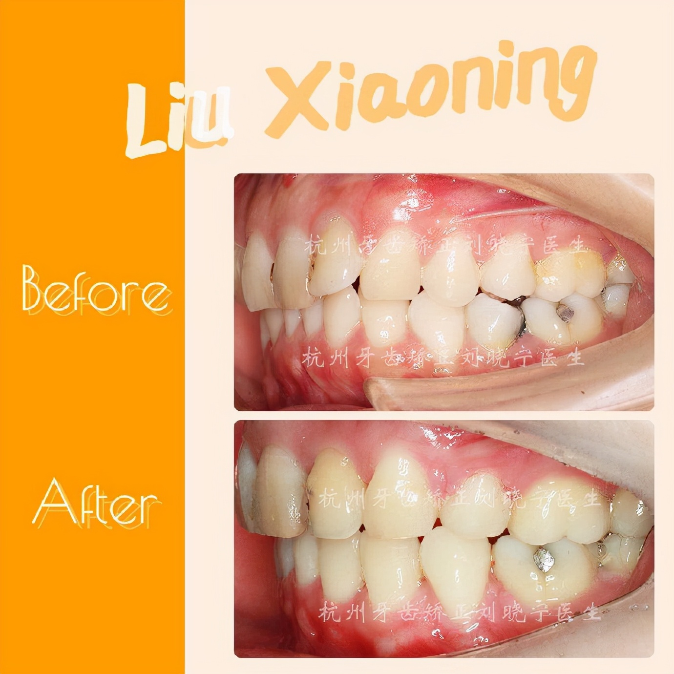 杭州舌侧牙齿矫正,舌侧矫正杭州价格