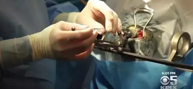 2021干细胞治疗脑卒中,2025年中国干细胞治疗