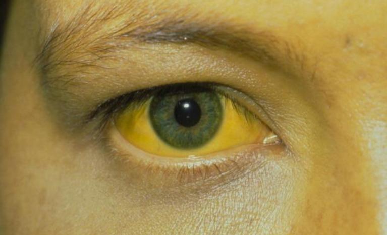 肝病脸上有4个征兆,面部出现4个问题