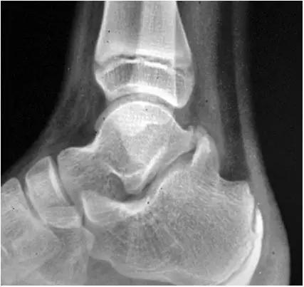 踝关节撞击症问诊,踝关节内侧撞击综合症位置图