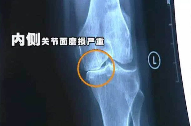 膝关节为何会退变?生活中少做哪些事,可预防膝骨关节炎?