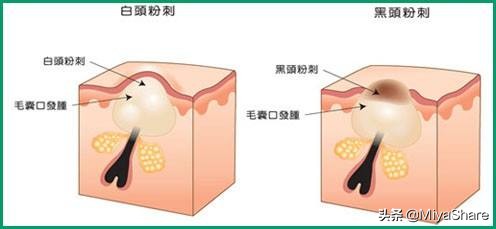 挤黑头的坑好多年了怎么处理,挤完黑头的正确处理方式