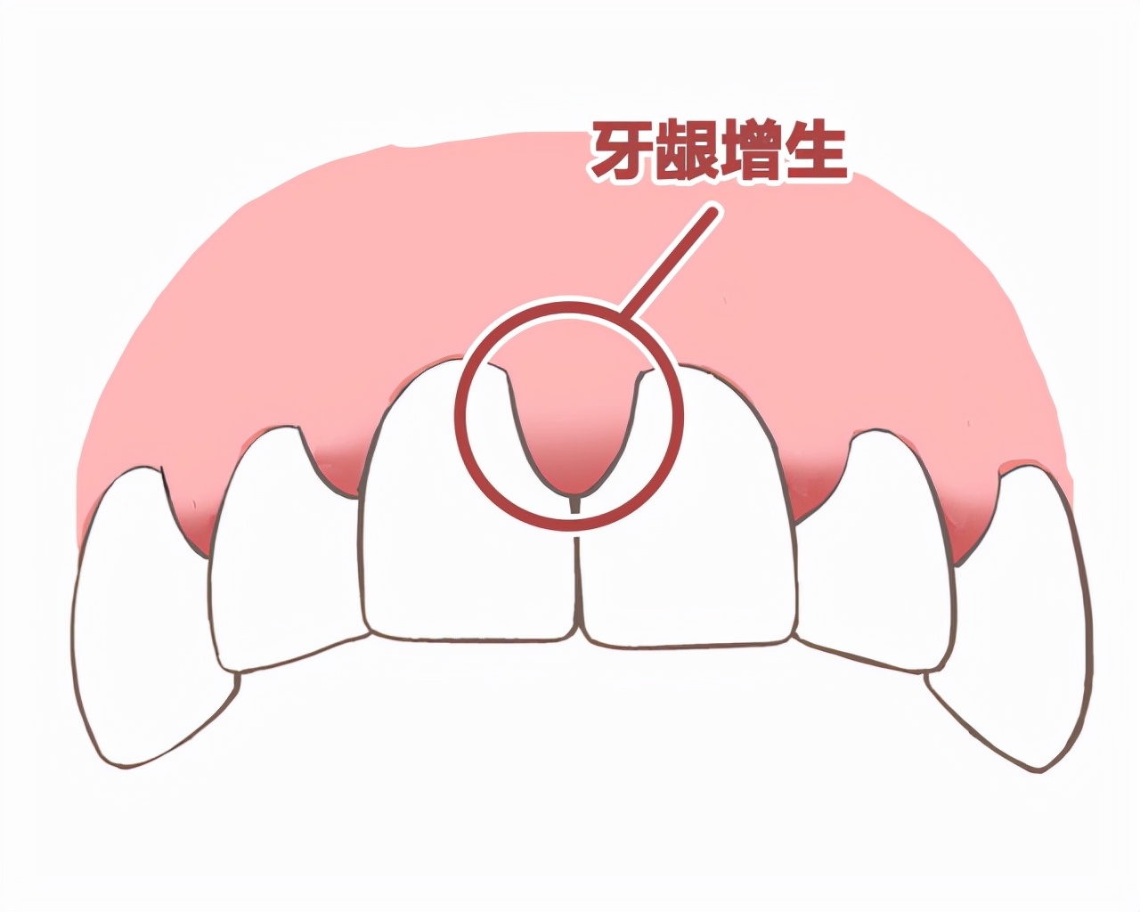 肾移植后可以修牙吗,肾移植后牙龈有点红肿带增生