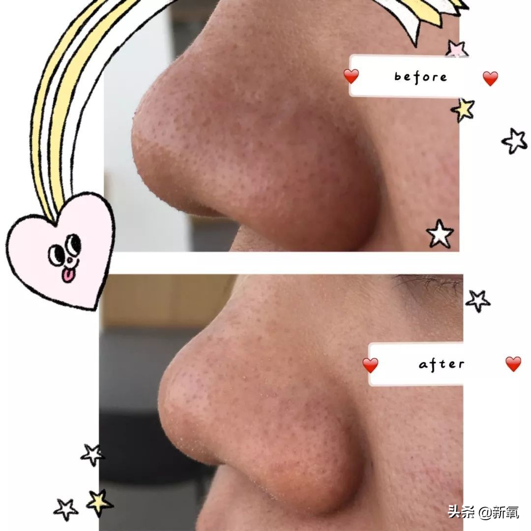 目前有真正去黑头的方法,最近超火的去黑头