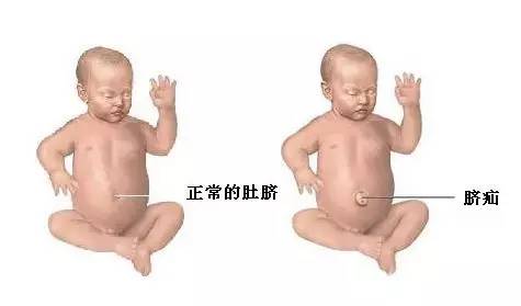 肚脐的形状决定了你的健康,如何根据肚脐形状了解身体