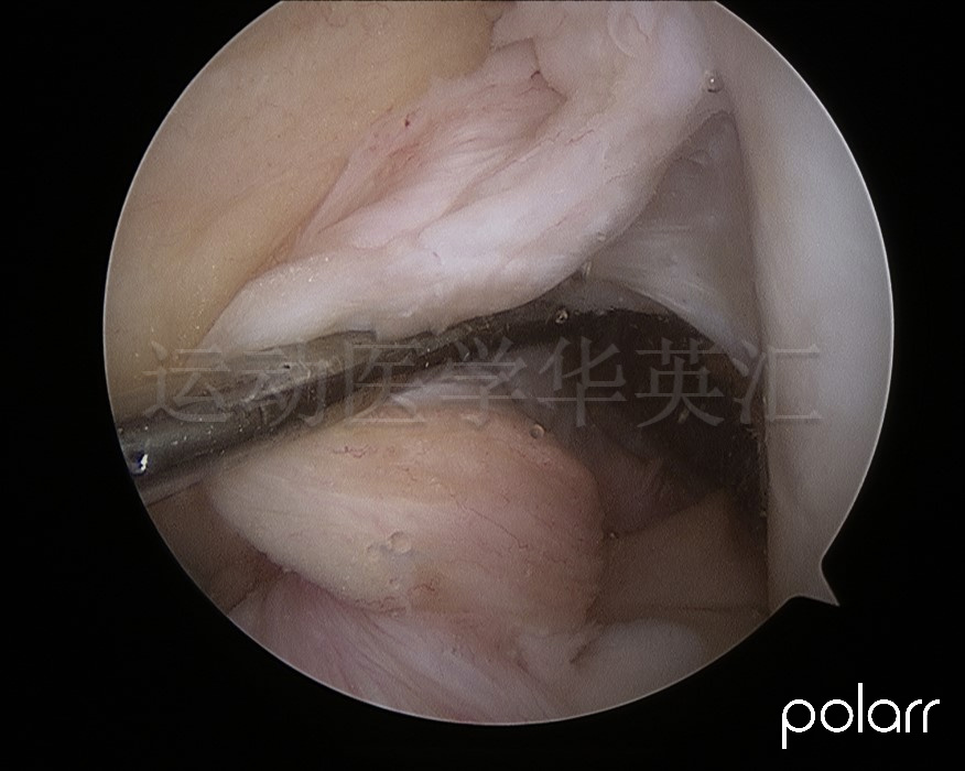 前交叉韧带断裂十年还需要治吗,前交叉韧带1°损伤能自愈吗