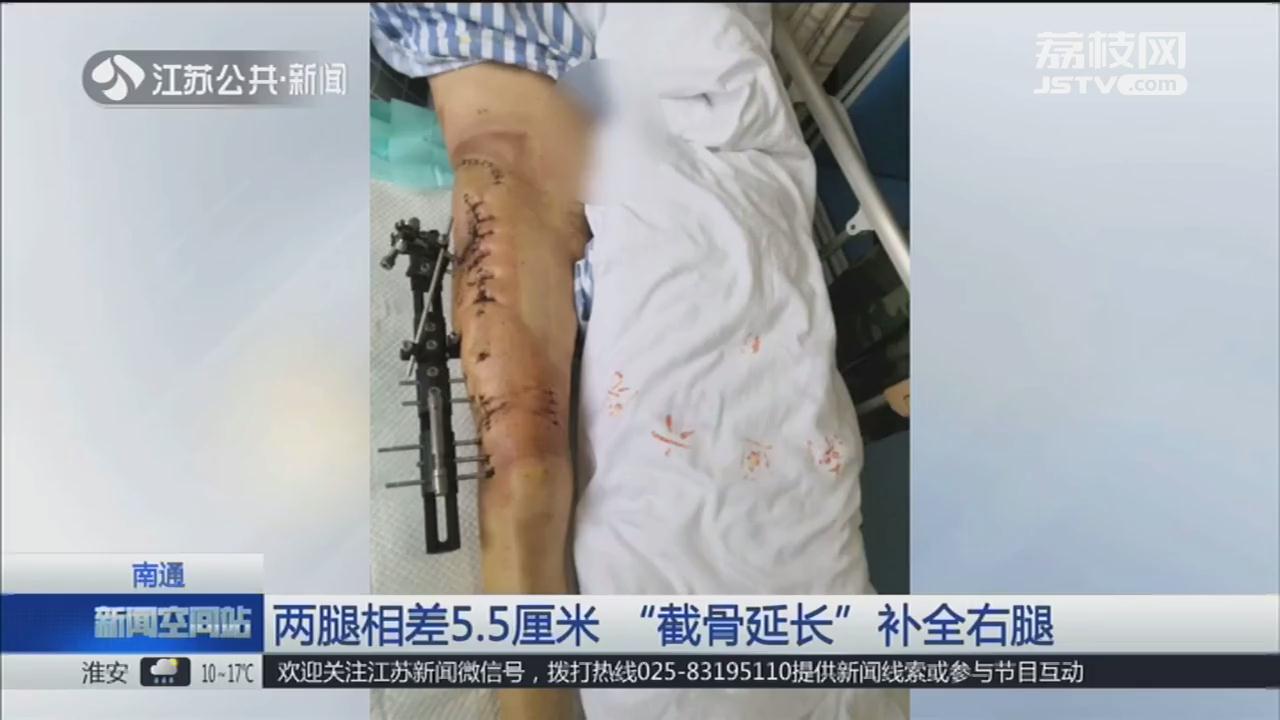 先髋截骨手术后腿会变长还是变短,右腿比左腿短2公分怎么办