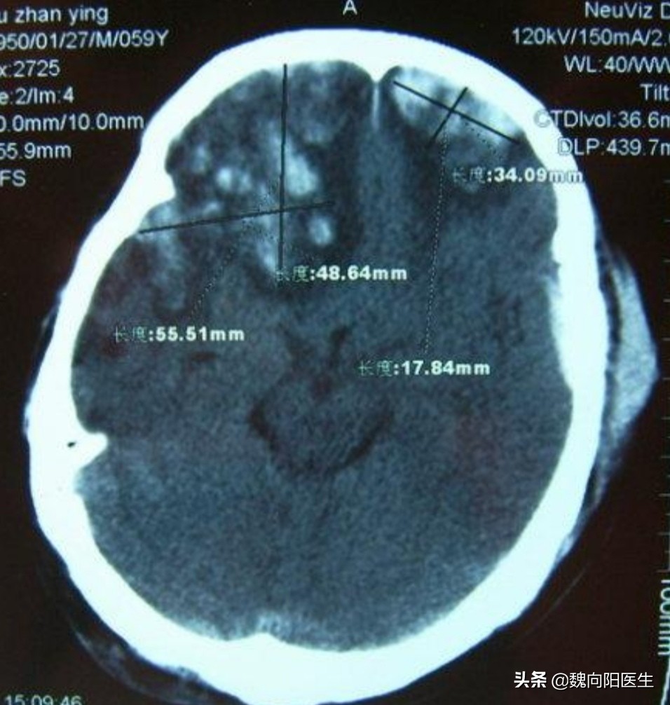 小孩后脑勺着地摔了出现呕吐,孩子摔倒后脑勺着地潜伏期