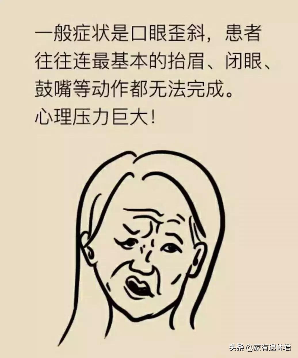 专家:冷暖交替谨防面瘫,短期面部受冷防止面瘫