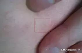 粟粒疹宝宝,宝宝红斑丘疹鉴别图谱