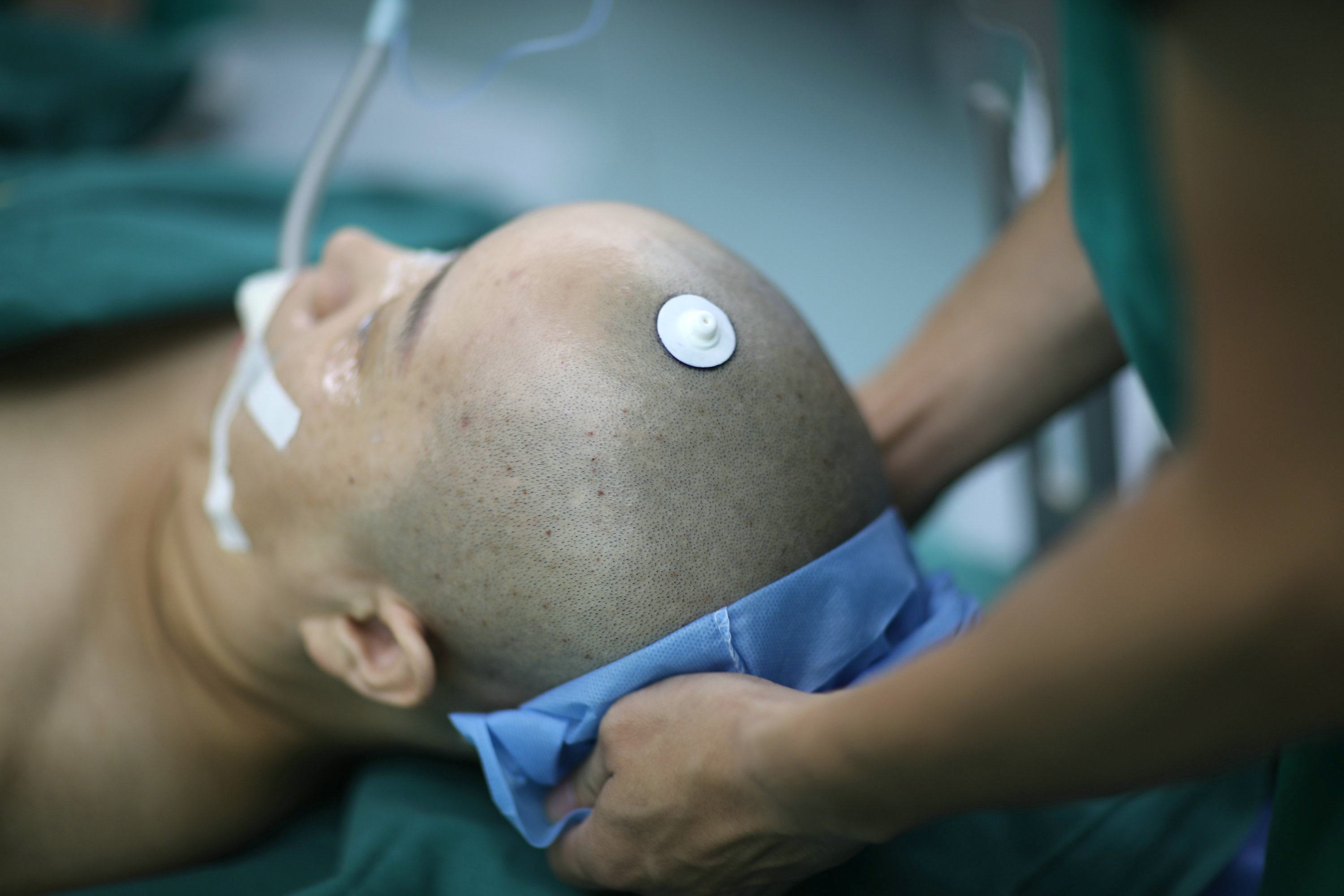 头部开颅手术多久过危险期,啥是开颅手术