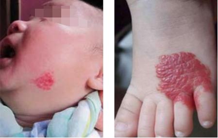 郴州市第一人民医院祛胎记,郴州第一人民医院治疗肝脏血管瘤