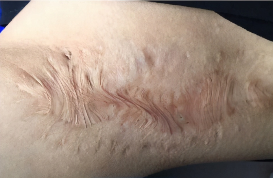 被火烫伤疤痕修复最好的方法,烧烫伤疤痕治疗的方法都有哪些