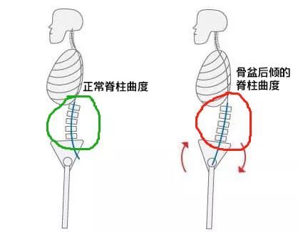 足内翻导致足弓疼,足内翻会导致什么腿型怎么改