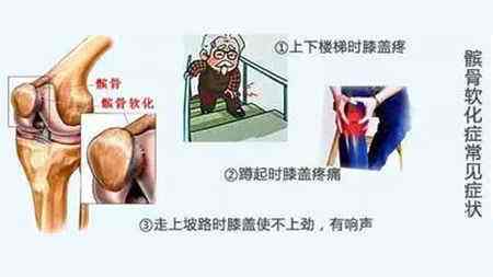 腿髌骨软化症怎么治疗,髌骨软化小腿僵硬