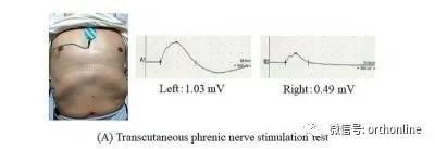 非单一类型颈椎病患者什么意思,颈椎病罕见吗好治吗