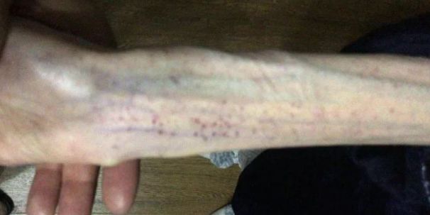 女生3个月不吃晚饭，子宫竟萎缩致停止发育！严重会致命...