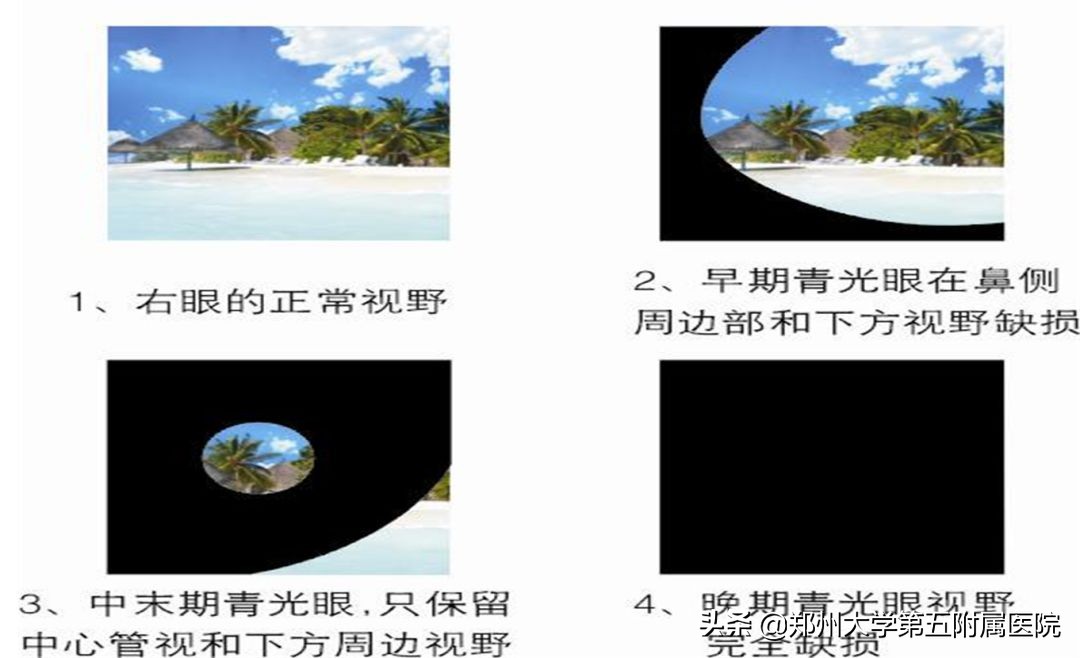年轻人须警惕青光眼偷走“光明”,警惕青光眼偷走你的视力