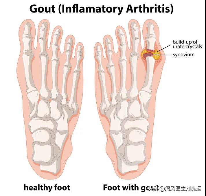 心血管疾病患者痛风吃什么药,痛风吃什么西药能快速止痛降尿酸