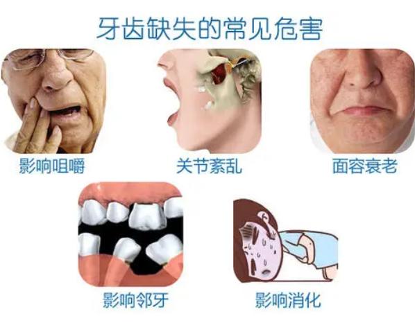 种植牙怎么选材料品牌,如何选择适合自己的种植牙品牌