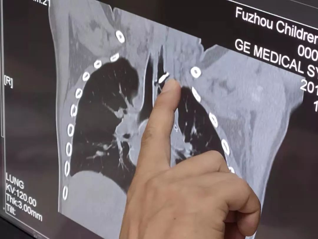 吞下“网线钉”浑然不觉，福州闽侯4岁男孩命悬一线