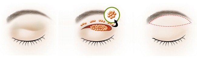 全切双眼皮修复过程经历真实,双眼皮失败修复费用由谁承担