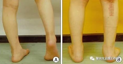 伊里扎洛夫外固定架治疗足部畸形,足部畸形矫正的技巧