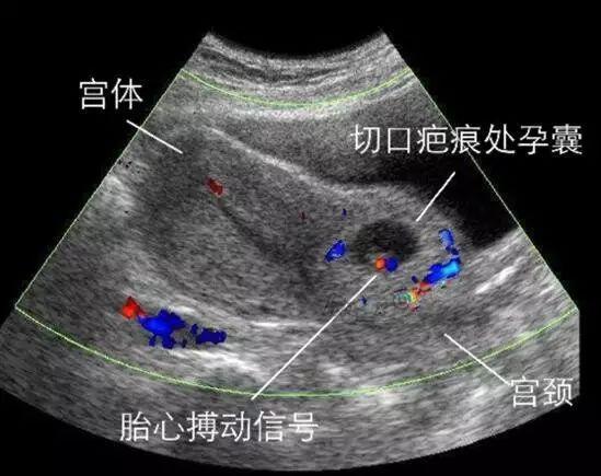 瘢痕妊娠是什么意思,瘢痕妊娠是什么