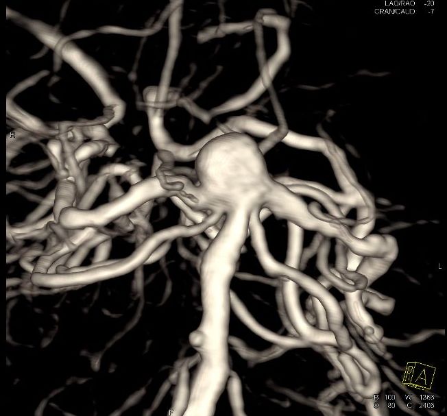 老年人基底动脉瘤几率,脑动脉瘤未破裂最佳治疗方法