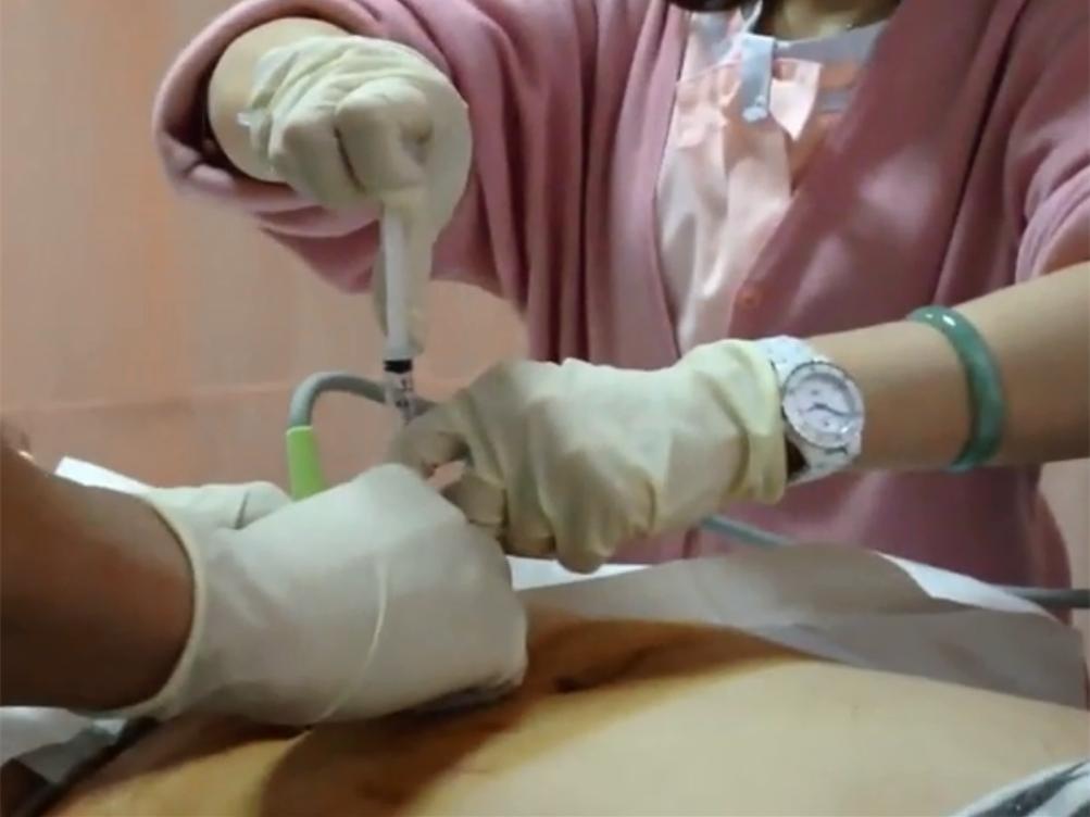 让孕妇妈妈提心吊胆的羊水穿刺,孕妈必须知道的羊水穿刺问题收藏