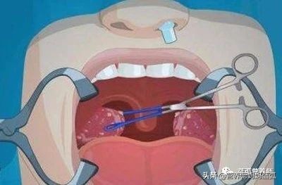 扁桃体炎经过抗炎治疗几天能好,扁桃体发炎中医辨证治疗