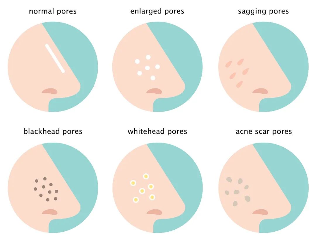 收缩毛孔轻松说拜拜,收缩毛孔不反弹最好的办法是什么