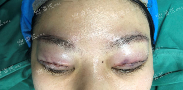 肿眼泡抽脂肪埋线双眼皮效果,肿眼泡割双眼皮长脂肪
