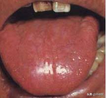 最实用的舌诊图六大舌象,舌诊深入学习书