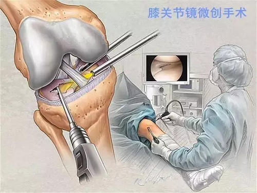 膝关节软骨移植手术风险大吗,膝关节软骨移植手术后多久能康复