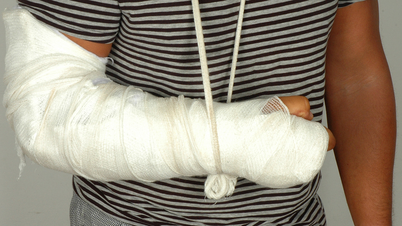 骨折后保守治疗需要注意什么,骨折手术有几种固定方法