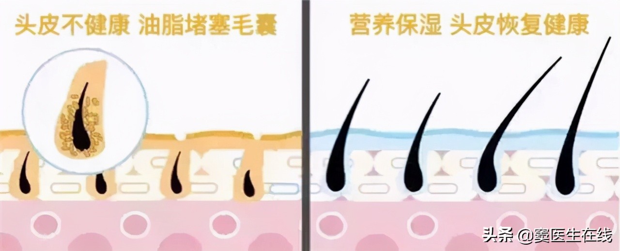 体毛太多能刮掉吗?两处的体毛尽量不要刮,刮掉对身体没好处