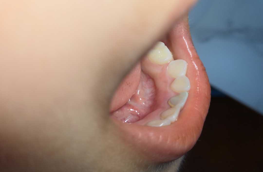 换牙期小朋友牙神经疼,小朋友换牙牙齿很疼