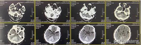 高血压小脑出血治愈率多大,高血压导致小脑出血