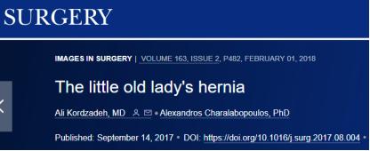 腹股沟疝有几种类型如何鉴别,腹股沟疝有哪些特点