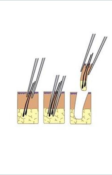 头发种植是怎么操作的,头发种植利弊有哪些呢