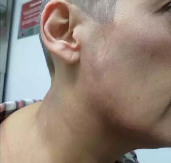 狼疮肾炎羟氯喹需服多久,慢性的肾炎可以用羟氯喹吗