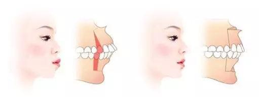骨性龅牙做正畸还是正颌,骨性龅牙正颌手术前要正畸吗