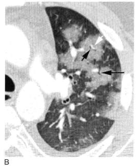 肺实变和肺炎的影像学区别,肺实变图