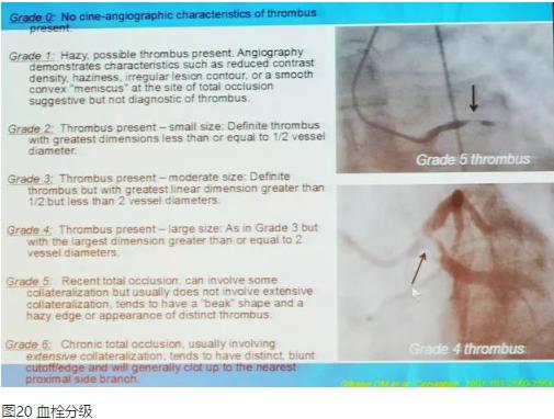 清晰完整揭秘冠脉造影全部过程,冠脉造影教学视频