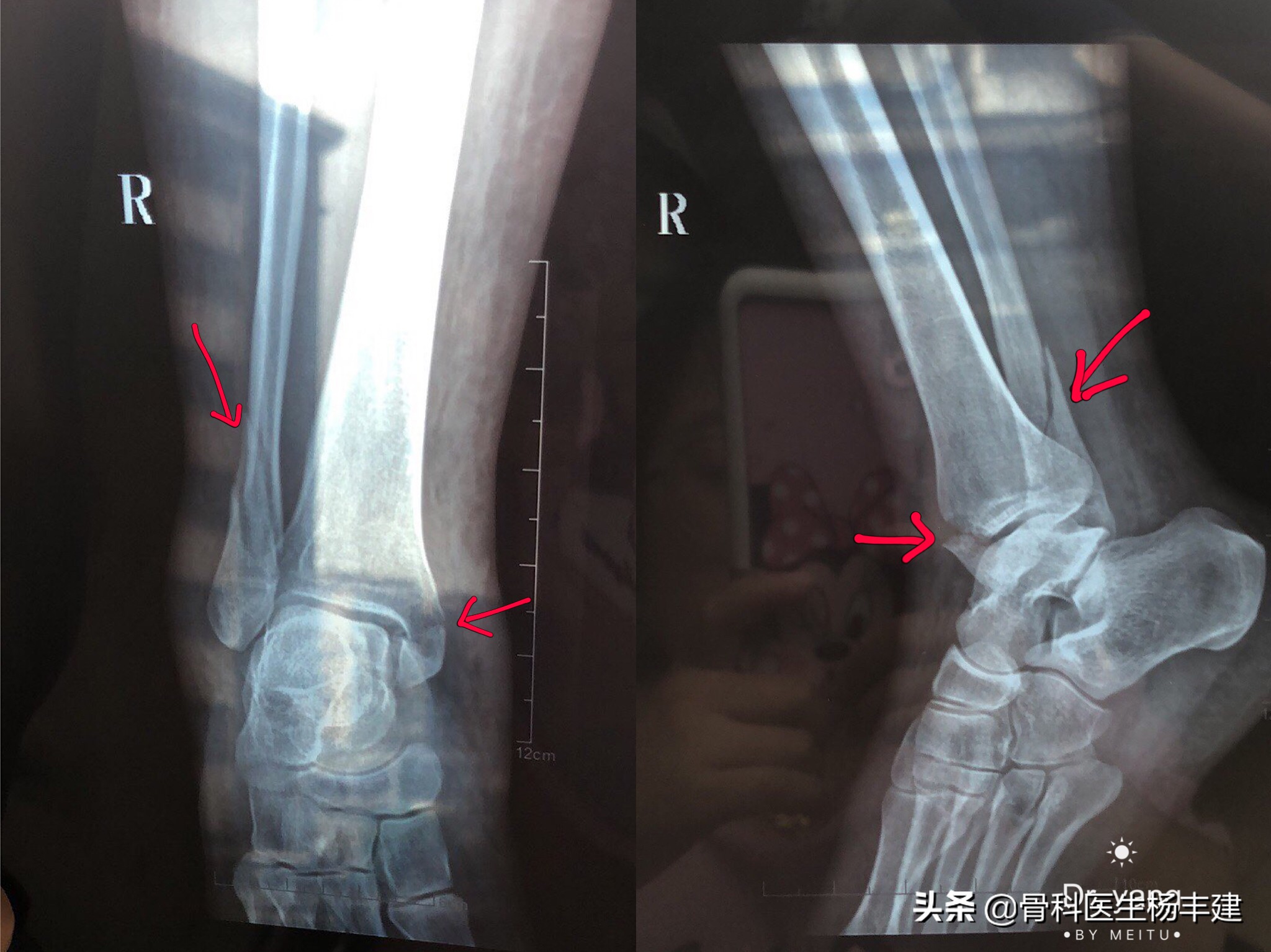 脚踝骨折做手术大概多少钱,右脚踝骨折做手术要多少小时